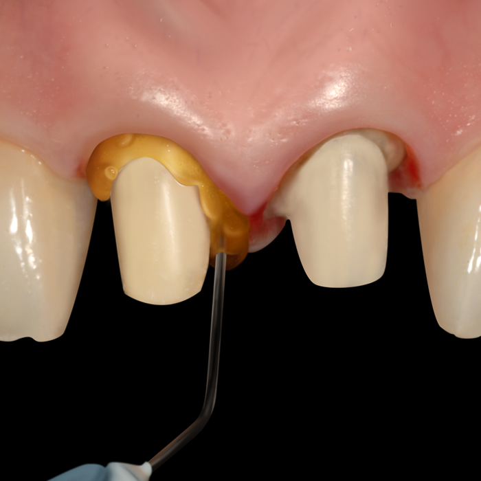 Retrax Gel FS® - Pro Pack — Pike Dental Supply Co.
